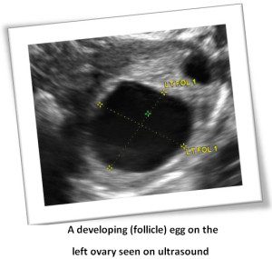 Attain Ivf Multi Cycle Program